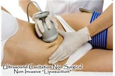 MySliM - Non-Surgical Ultrasound Liposuction image 2