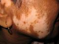 Dermatologist Durban - Dr. Imraan Jhetam image 4