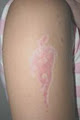 Tattoo,Stretch marks,Hair removal-Laser Clinic image 2