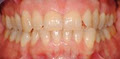 ZOOM! teeth whitening image 2