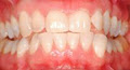 ZOOM! teeth whitening image 3